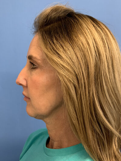 Chin Augmentation Case 37596 Before Photo Chin Augmentation