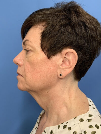 Face & Neck Lift Case 37590 Before Photo Face & Neck Lift