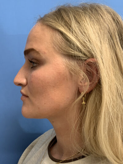 Rhinoplasty