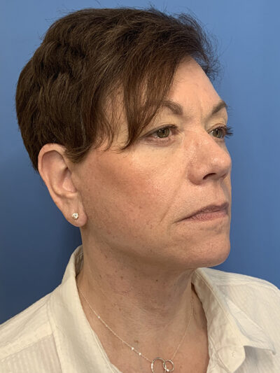 Face & Neck Lift Case 37590 After Photo Face & Neck Lift