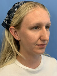 Rhinoplasty
