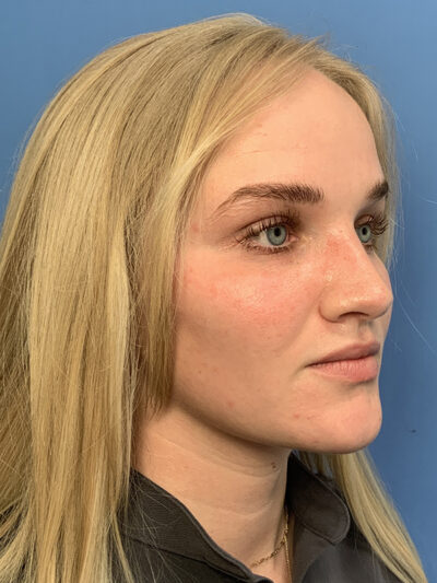 Rhinoplasty
