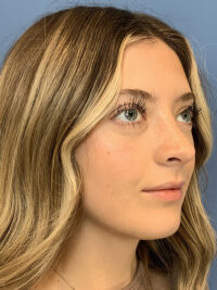 Rhinoplasty