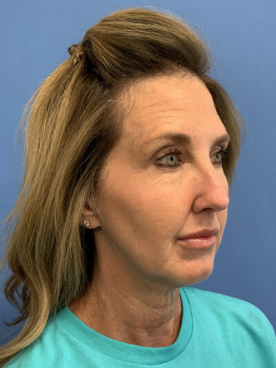 Chin Augmentation Case 37596 Before Photo Chin Augmentation