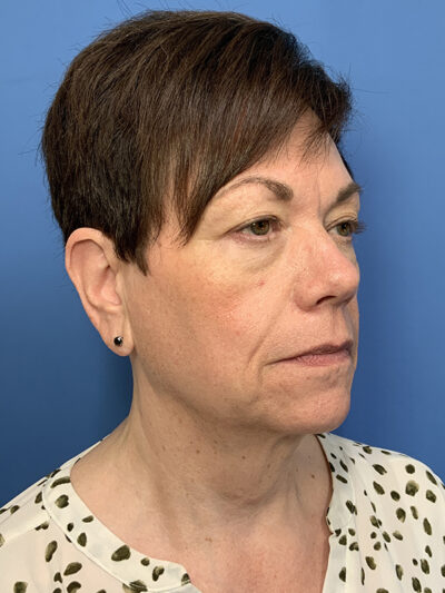 Face & Neck Lift Case 37590 Before Photo Face & Neck Lift