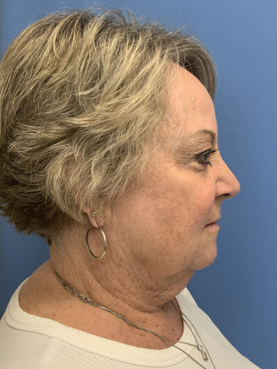 Face & Neck Lift