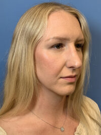 Rhinoplasty