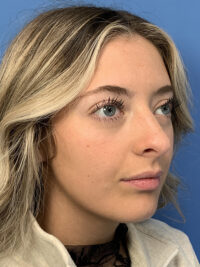 Rhinoplasty