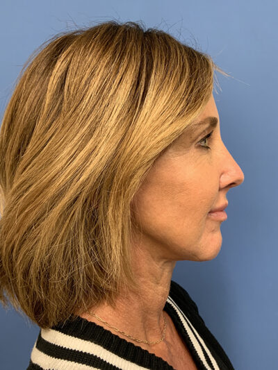 Chin Augmentation Case 37596 After Photo Chin Augmentation