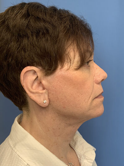 Face & Neck Lift Case 37590 After Photo Face & Neck Lift
