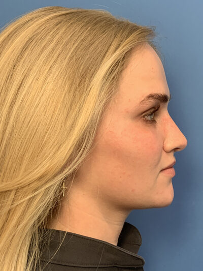 Rhinoplasty