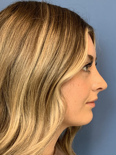 Rhinoplasty