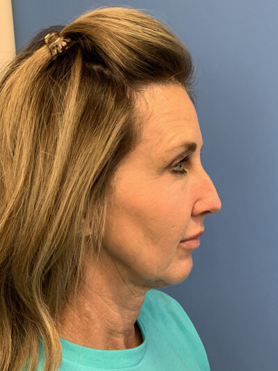 Chin Augmentation Case 37596 Before Photo Chin Augmentation