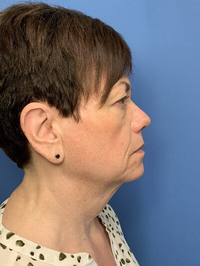 Face & Neck Lift Case 37590 Before Photo Face & Neck Lift