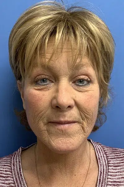 After image of female patient post facelift surgery
