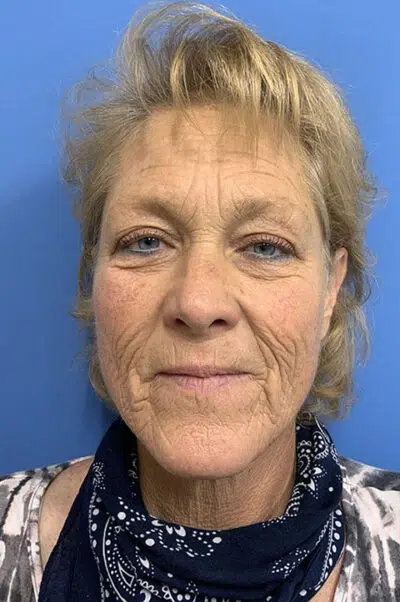 Before image of female patient pre facelift surgery