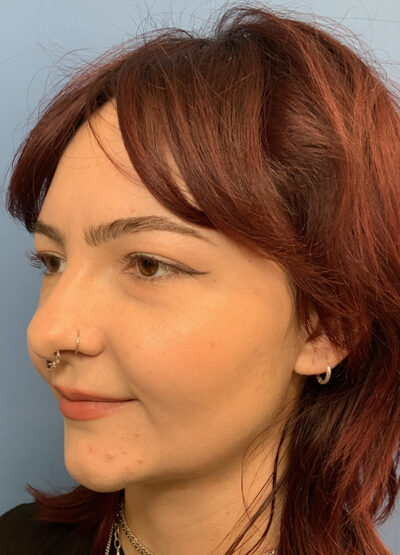 Submentoplasty