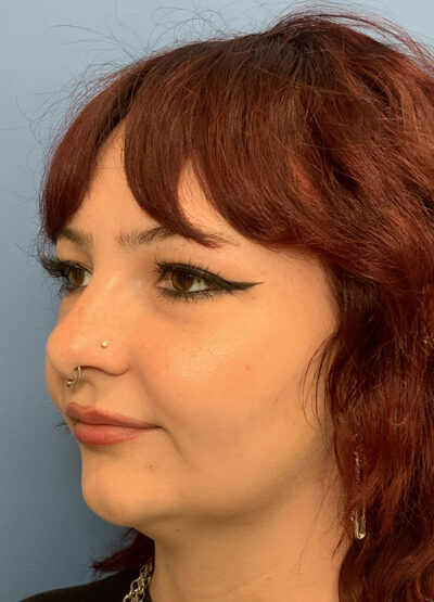 Submentoplasty