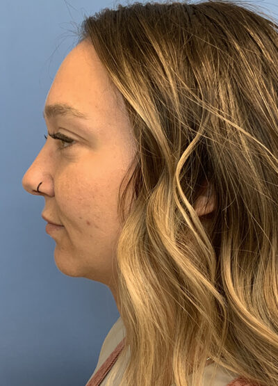 Submentoplasty