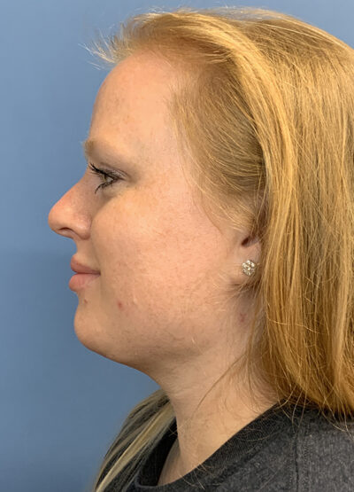 Submentoplasty