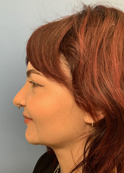 Submentoplasty