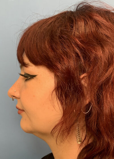 Submentoplasty