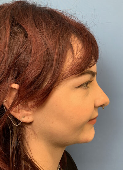 Submentoplasty