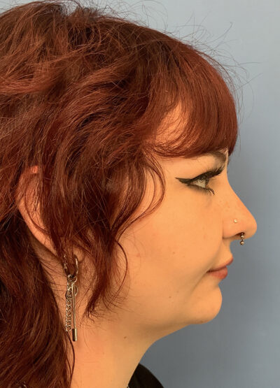 Submentoplasty