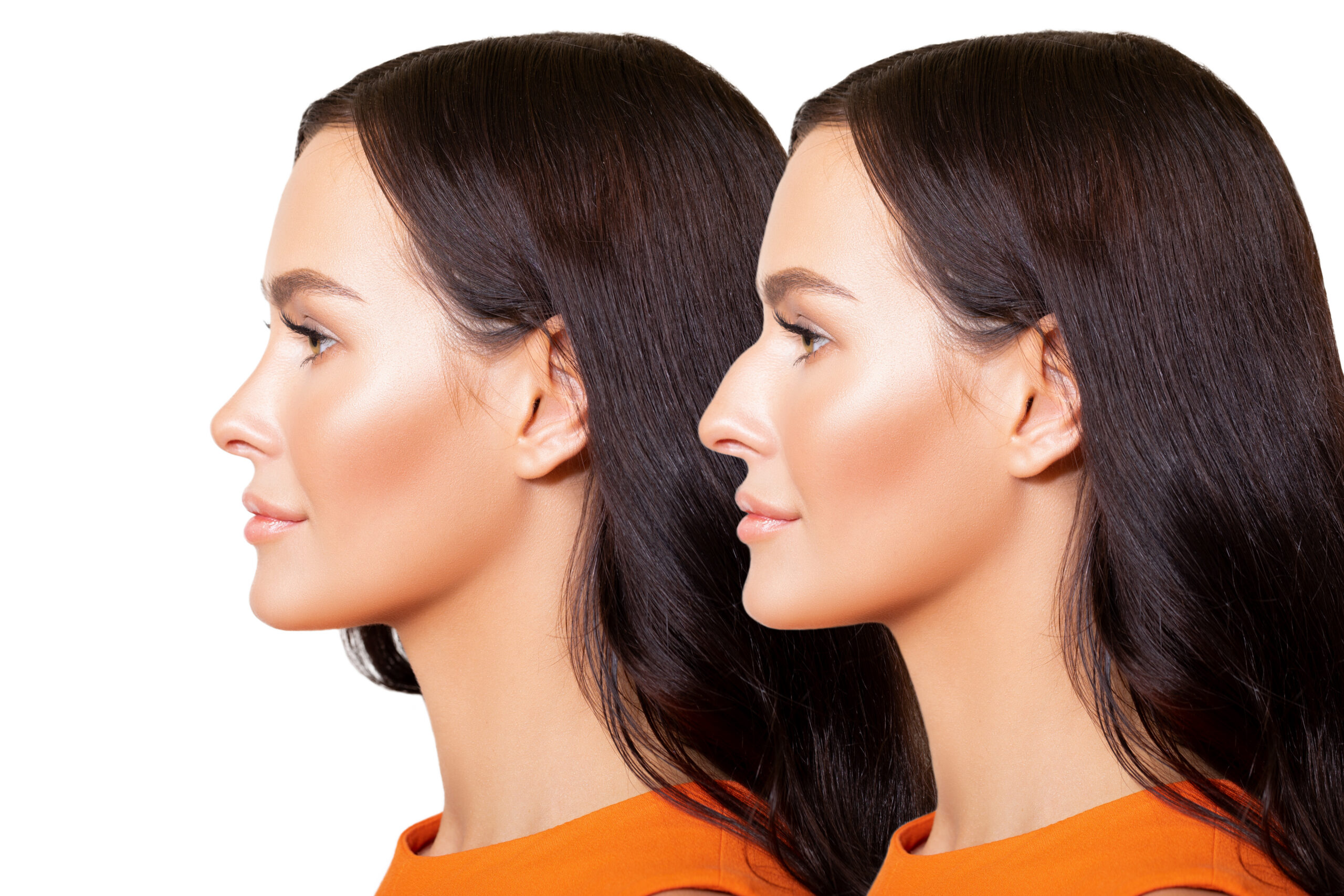 Blepharoplasty St. George