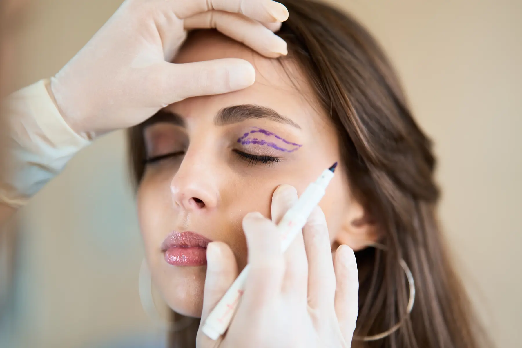 Woman undergoing pre-surgery eyelid marking procedure.